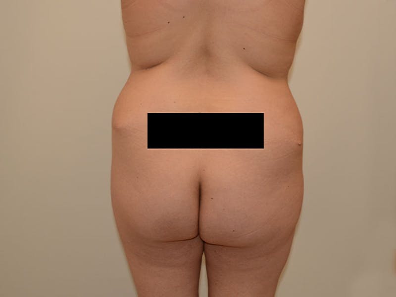 Liposuction Before & After Gallery - Patient 120905217 - Image 3