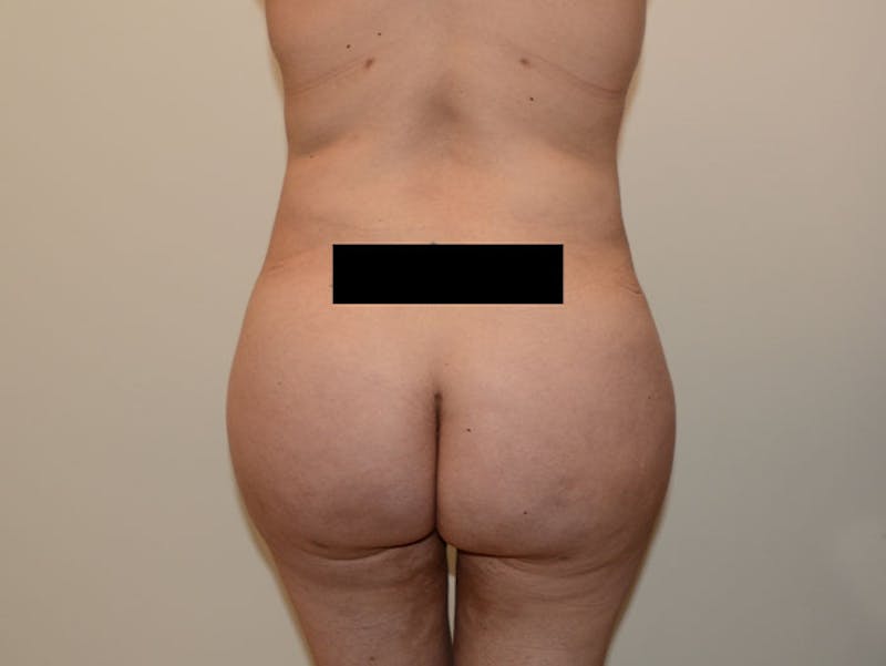 Liposuction Before & After Gallery - Patient 120905217 - Image 4