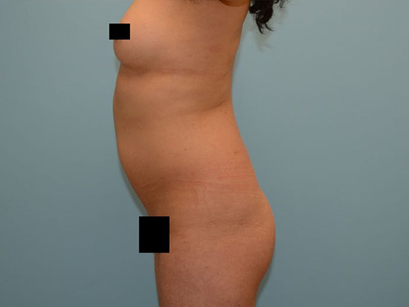 Liposuction Before & After Gallery - Patient 120905224 - Image 1
