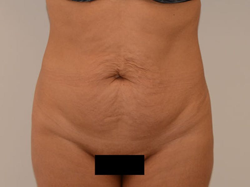 Liposuction Before & After Gallery - Patient 120905229 - Image 1