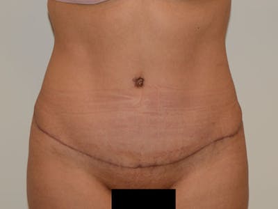Liposuction Before & After Gallery - Patient 120905229 - Image 2
