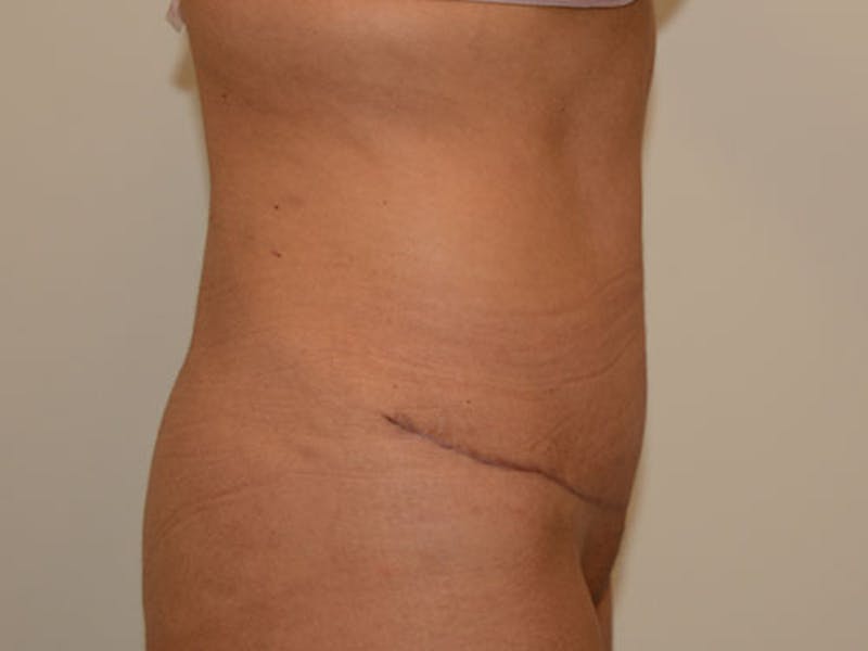 Liposuction Before & After Gallery - Patient 120905229 - Image 4