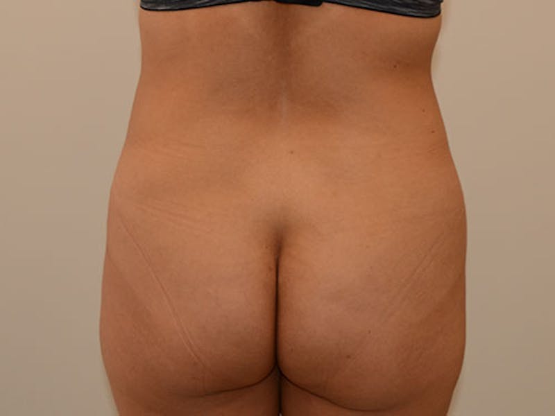 Liposuction Gallery - Patient 120905229 - Image 5