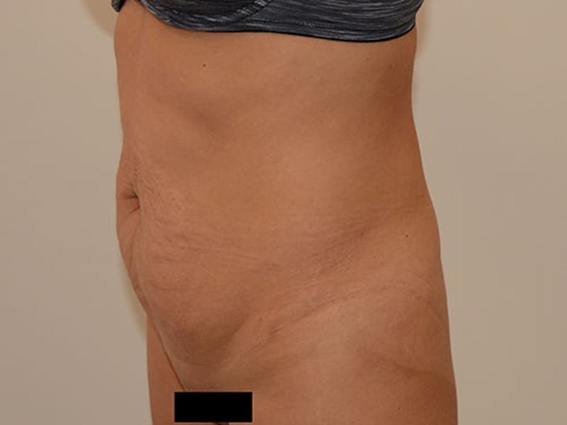 Liposuction Gallery - Patient 120905229 - Image 7
