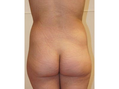 Liposuction Gallery - Patient 120905233 - Image 1