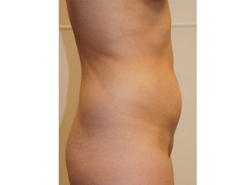 Liposuction Before & After Gallery - Patient 120905233 - Image 5
