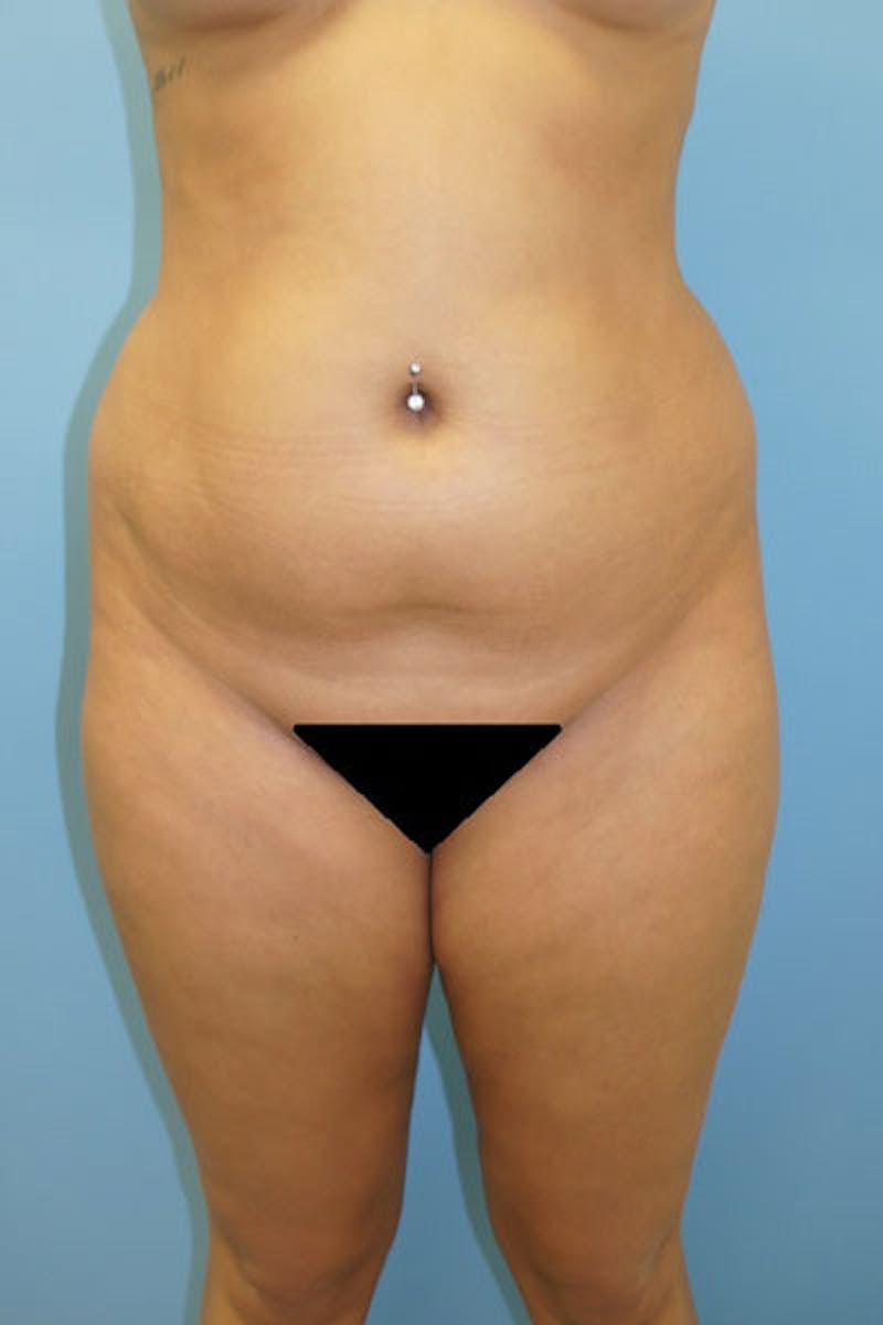 Liposuction Before & After Gallery - Patient 120905236 - Image 1