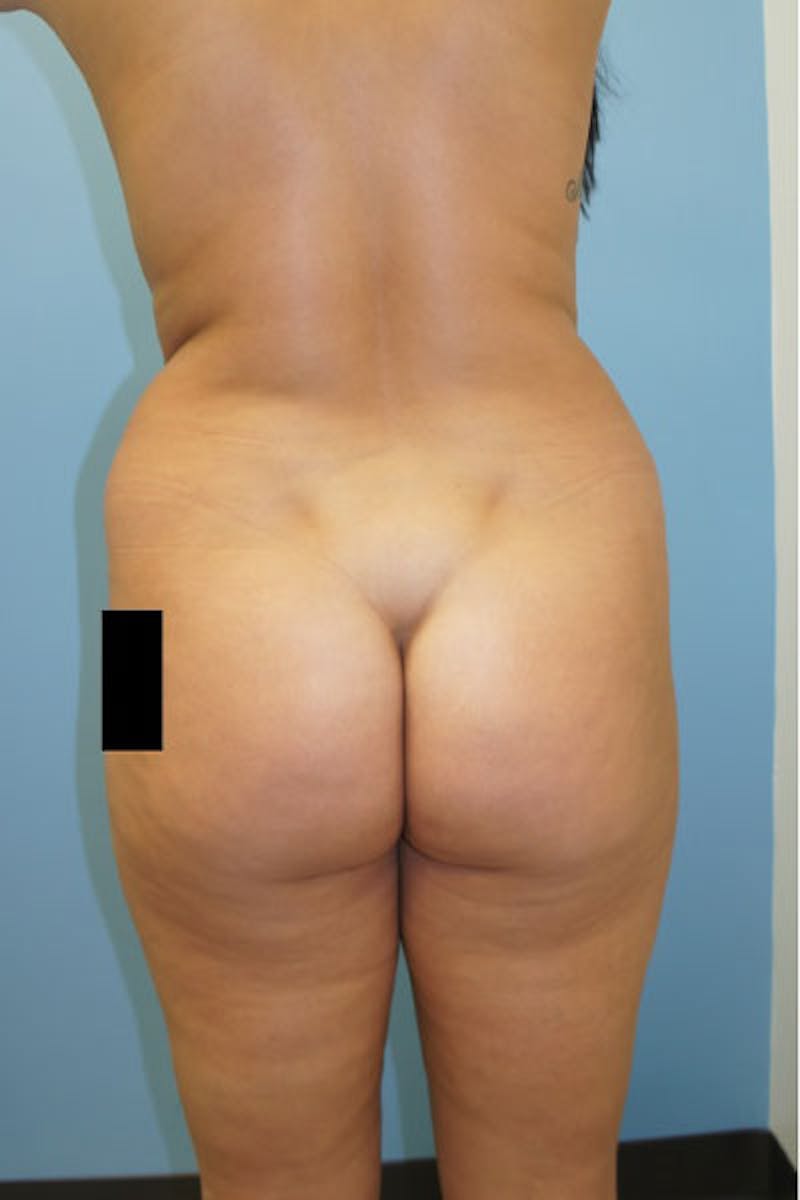 Liposuction Before & After Gallery - Patient 120905236 - Image 3