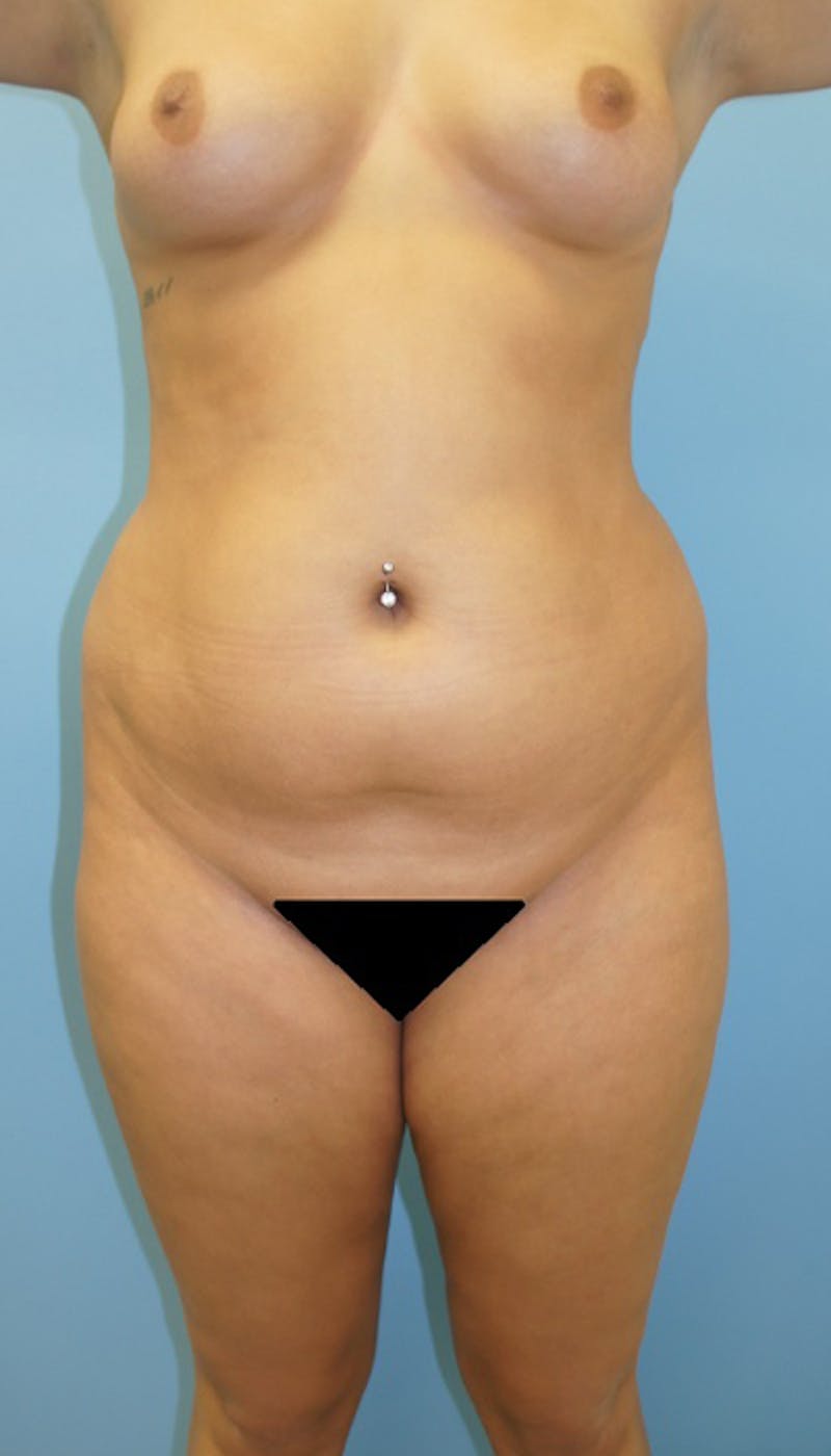 Liposuction Before & After Gallery - Patient 120905237 - Image 1