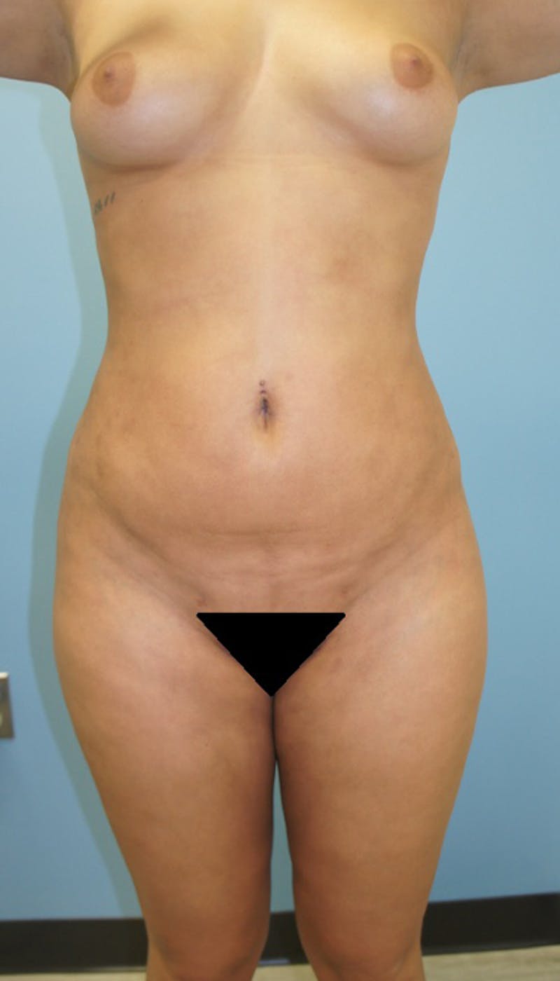 Liposuction Before & After Gallery - Patient 120905237 - Image 2
