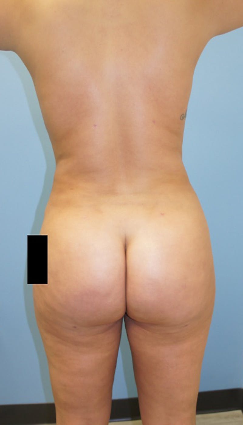 Liposuction Before & After Gallery - Patient 120905237 - Image 4