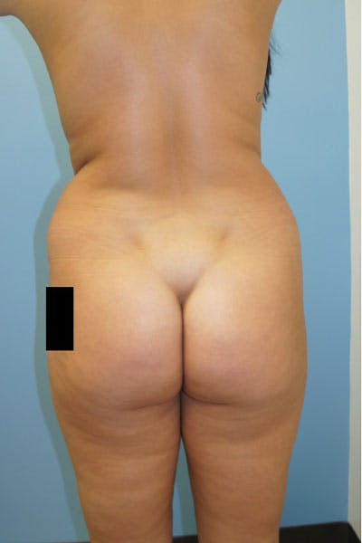 Liposuction Before & After Gallery - Patient 120905247 - Image 1