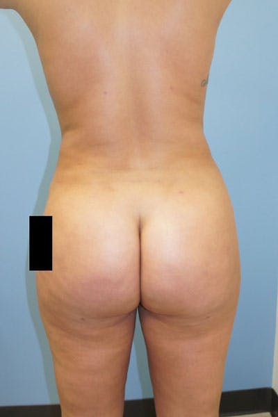 Liposuction Gallery - Patient 120905247 - Image 2
