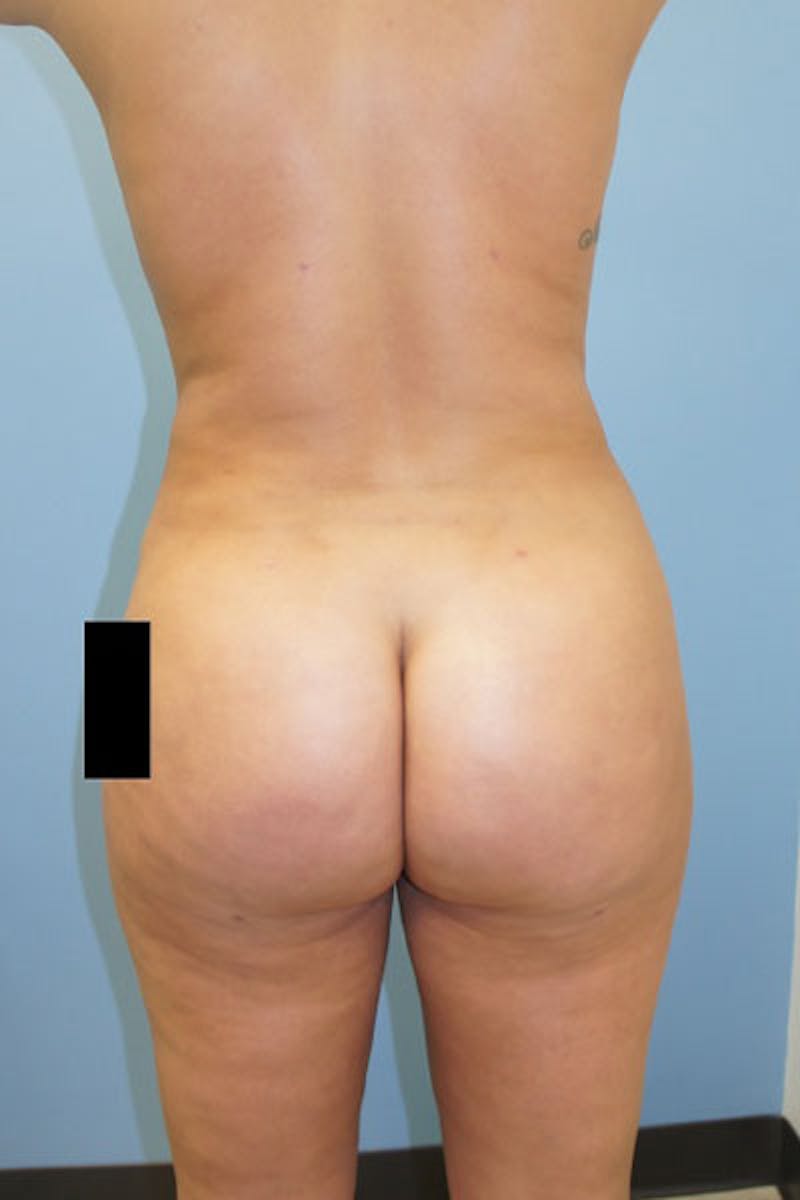 Liposuction Before & After Gallery - Patient 120905247 - Image 2
