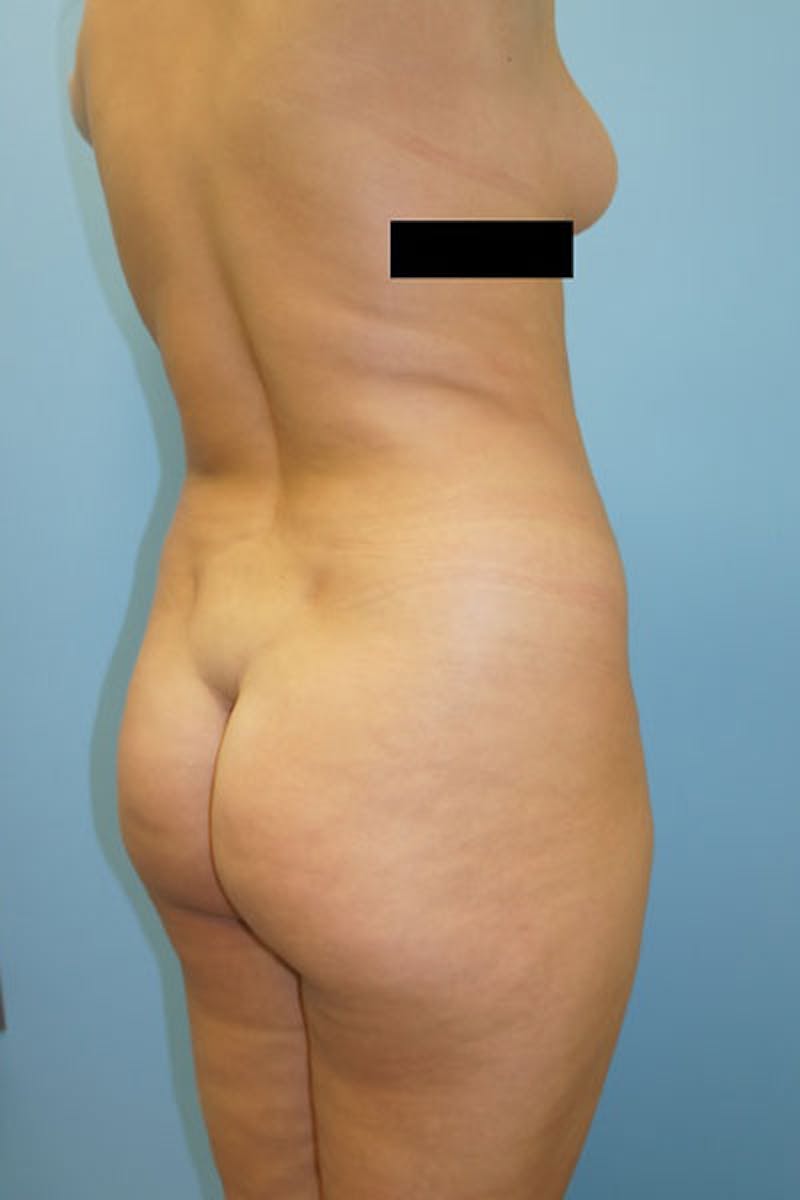 Liposuction Gallery - Patient 120905247 - Image 3