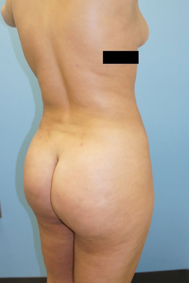 Liposuction Before & After Gallery - Patient 120905247 - Image 4