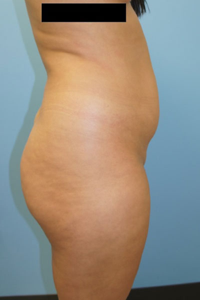 Liposuction Gallery - Patient 120905247 - Image 5