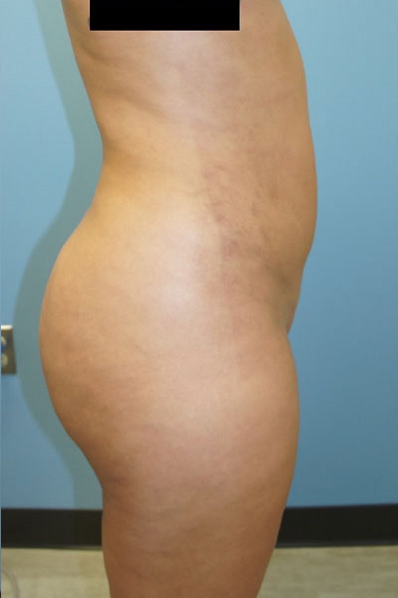 Liposuction Before & After Gallery - Patient 120905247 - Image 6