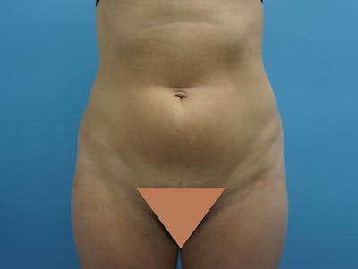 Liposuction Before & After Gallery - Patient 120905256 - Image 1