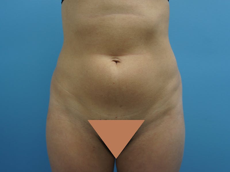 Liposuction Before & After Gallery - Patient 120905256 - Image 1