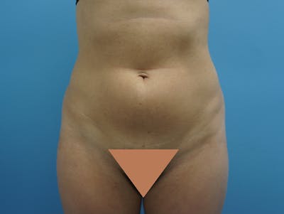 Liposuction Before & After Gallery - Patient 120905256 - Image 1
