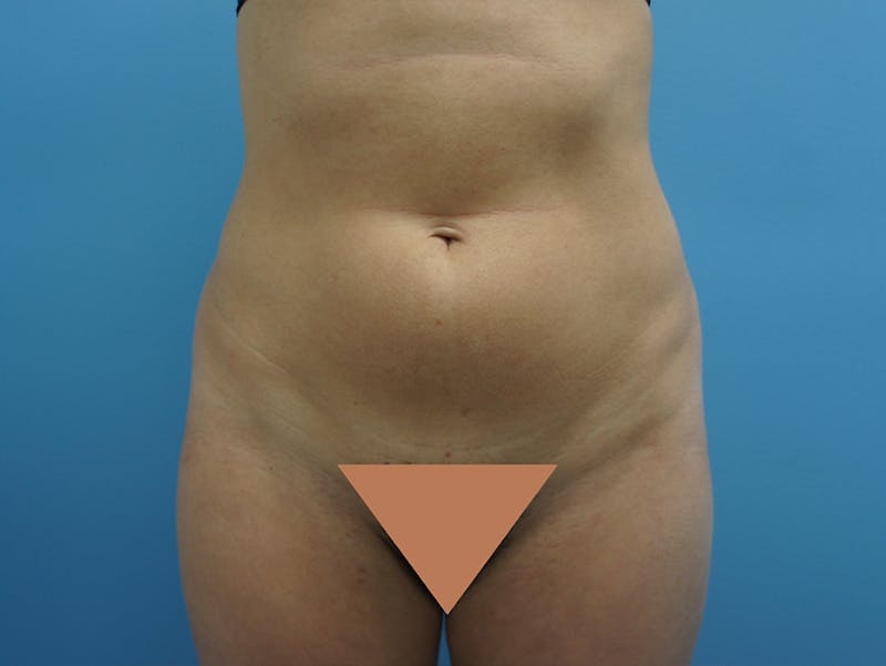 Liposuction Gallery - Patient 120905256 - Image 1