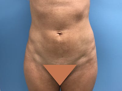 Liposuction Before & After Gallery - Patient 120905256 - Image 2