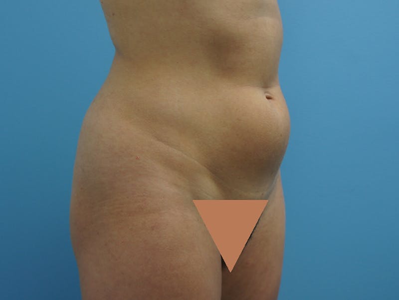 Liposuction Before & After Gallery - Patient 120905256 - Image 3