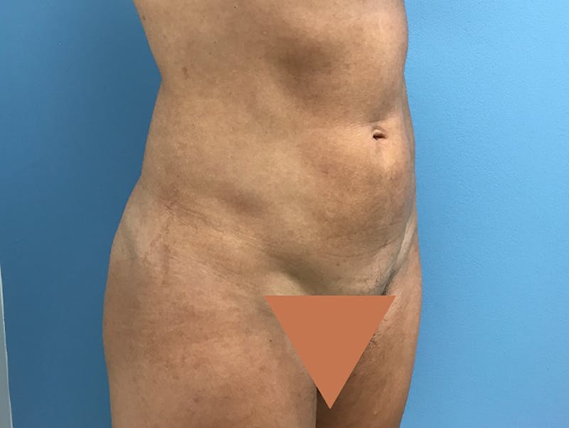 Liposuction Before & After Gallery - Patient 120905256 - Image 4