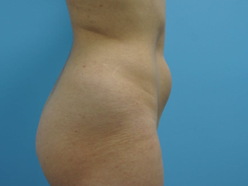Liposuction Before & After Gallery - Patient 120905256 - Image 5