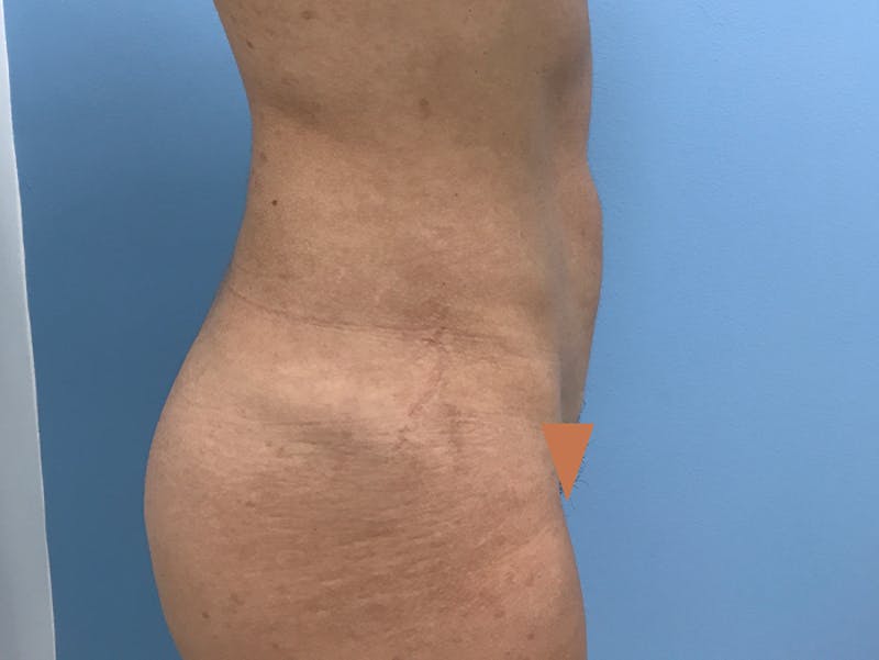 Liposuction Before & After Gallery - Patient 120905256 - Image 6