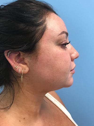 Liposuction Before & After Gallery - Patient 120905258 - Image 1