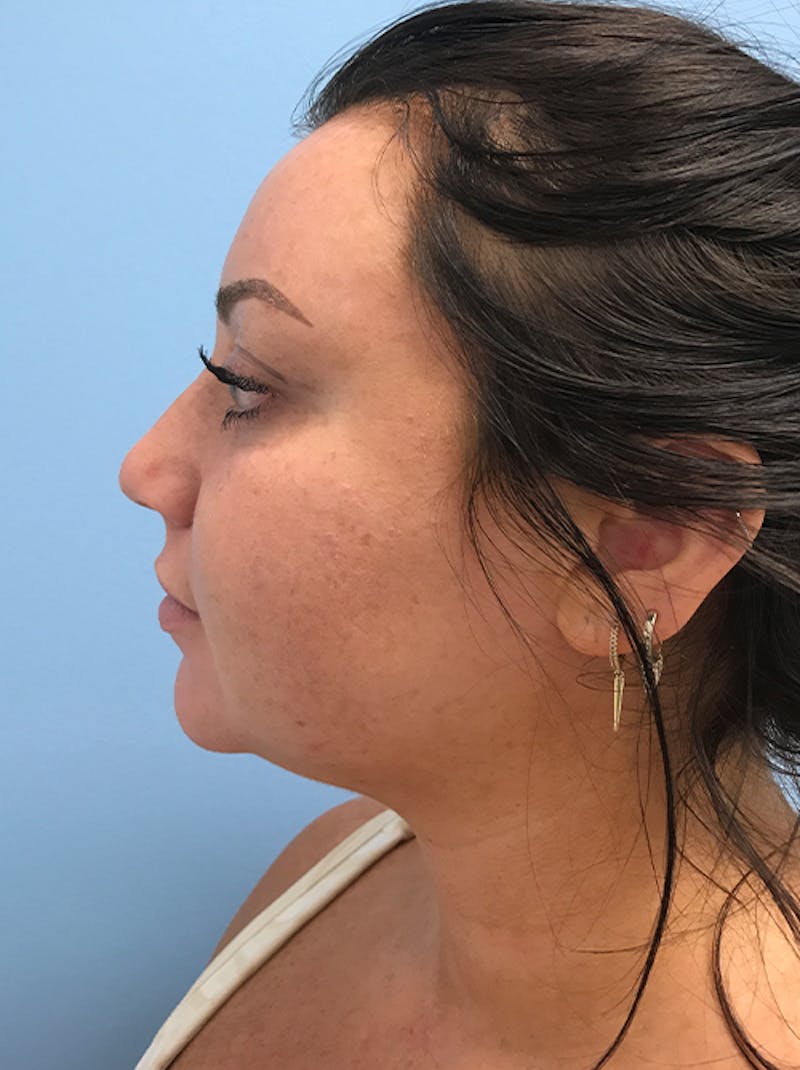 Liposuction Before & After Gallery - Patient 120905258 - Image 3