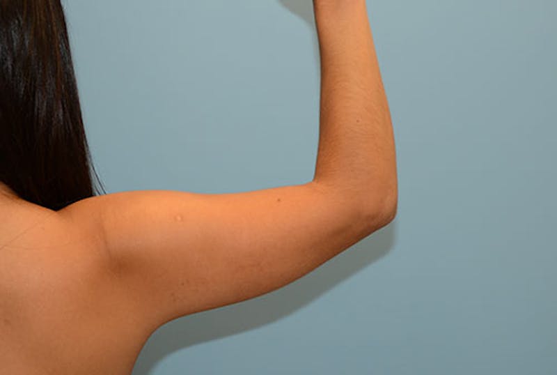 Liposuction Before & After Gallery - Patient 120905262 - Image 1