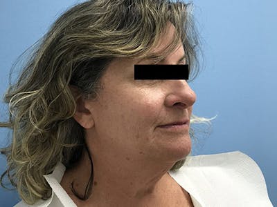 Liposuction Before & After Gallery - Patient 120905271 - Image 1
