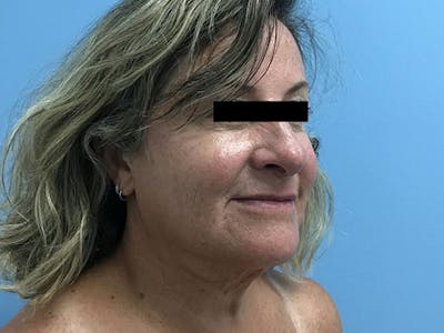 Liposuction Before & After Gallery - Patient 120905271 - Image 2