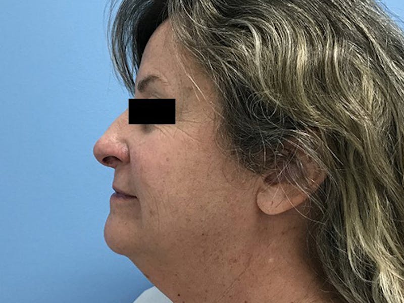 Liposuction Before & After Gallery - Patient 120905271 - Image 3