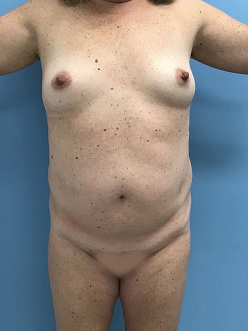 Liposuction Before & After Gallery - Patient 120905271 - Image 5