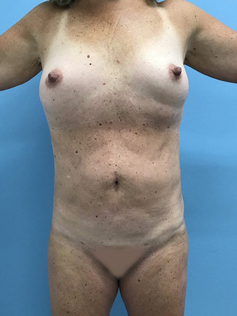 Liposuction Before & After Gallery - Patient 120905271 - Image 6