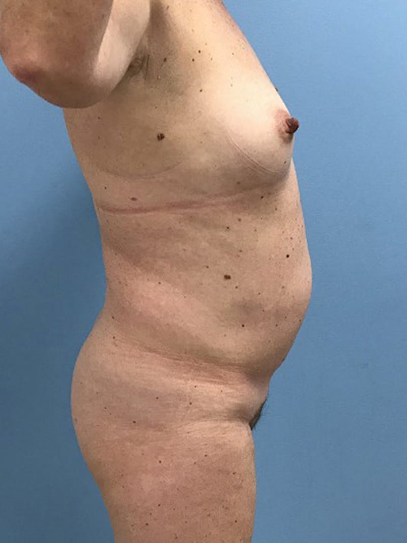 Liposuction Before & After Gallery - Patient 120905271 - Image 7