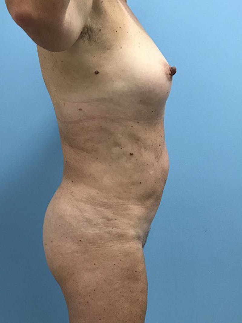 Liposuction Before & After Gallery - Patient 120905271 - Image 8