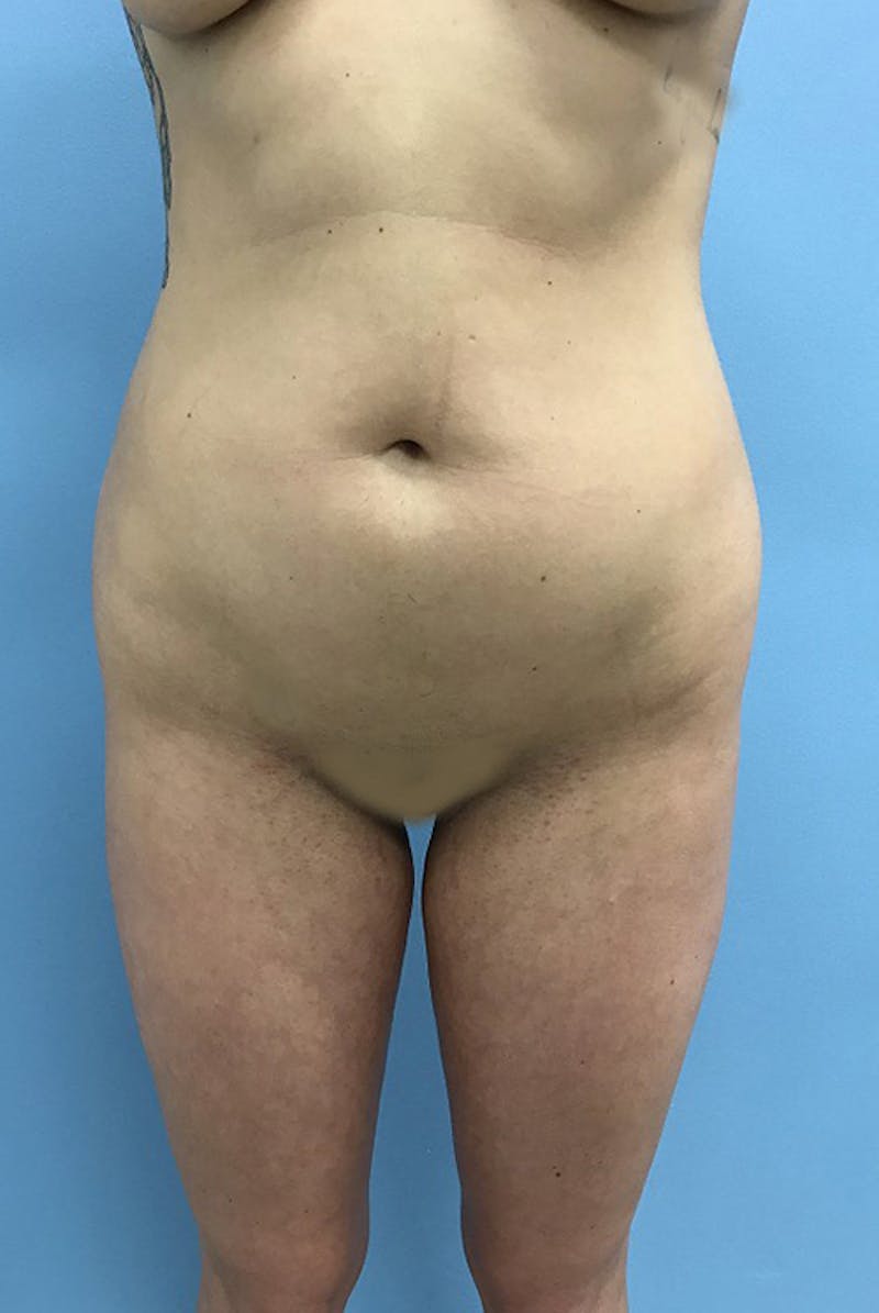 Liposuction Before & After Gallery - Patient 120905273 - Image 1