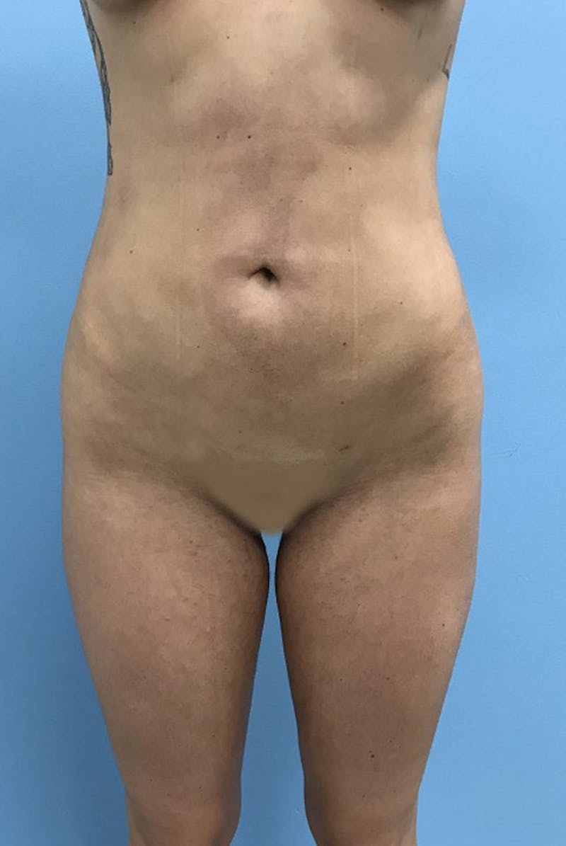 Liposuction Gallery - Patient 120905273 - Image 2