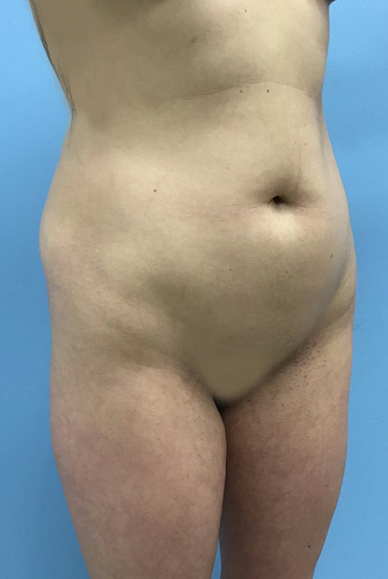 Liposuction Gallery - Patient 120905273 - Image 3