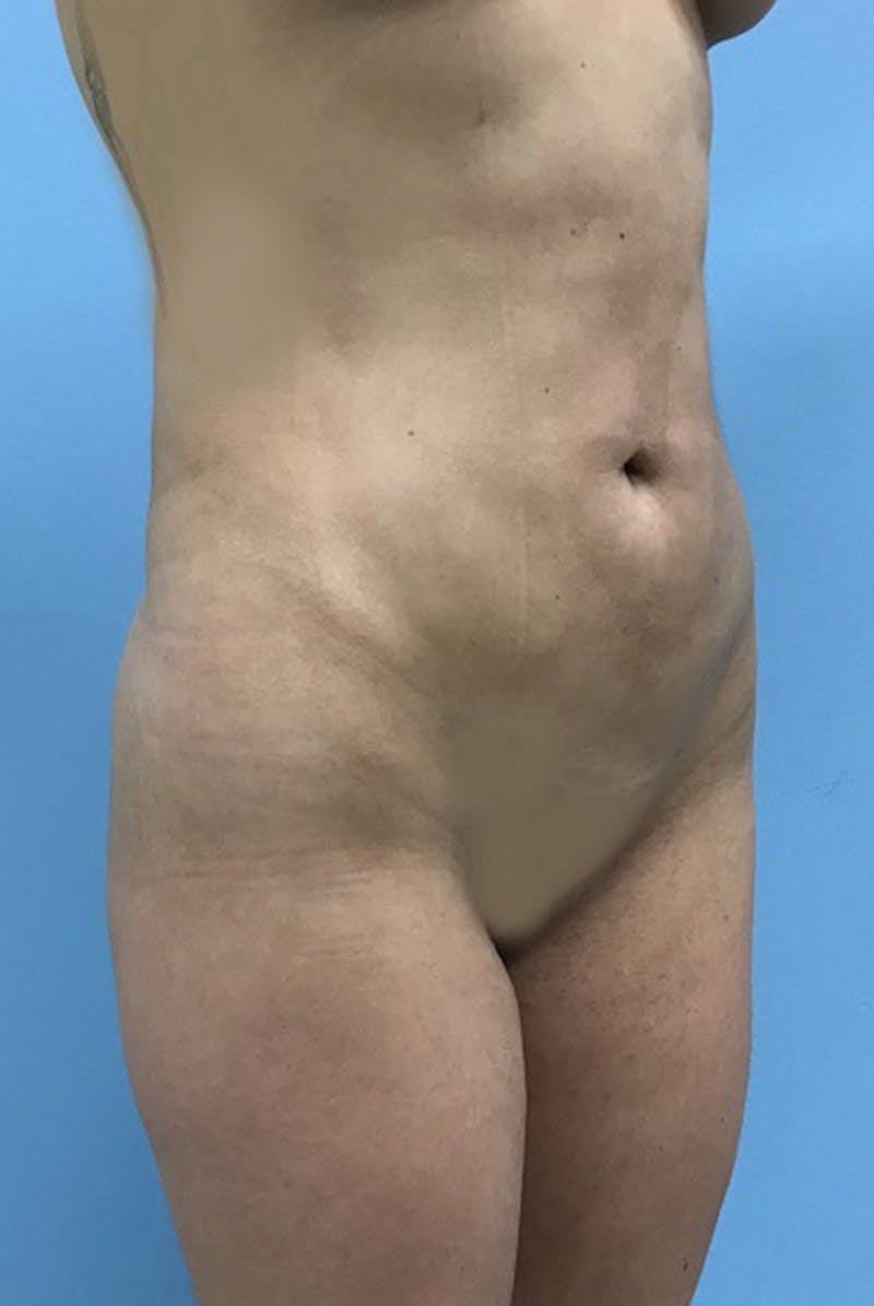 Liposuction Gallery - Patient 120905273 - Image 4
