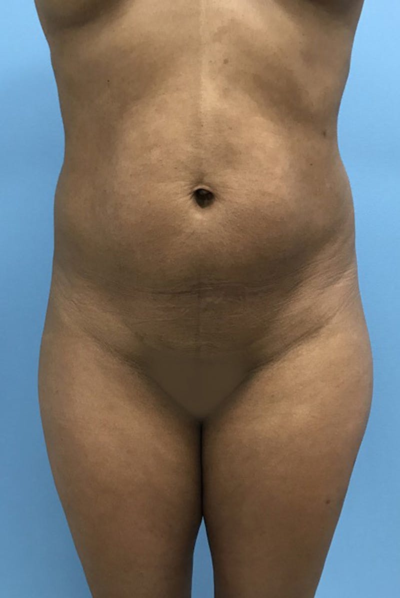 Liposuction Before & After Gallery - Patient 120905276 - Image 1