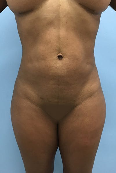 Liposuction Gallery - Patient 120905276 - Image 2