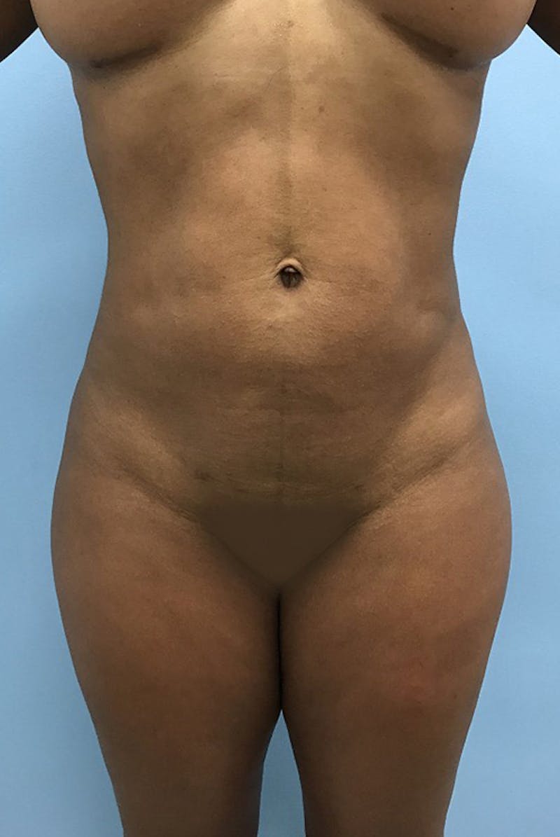 Liposuction Before & After Gallery - Patient 120905276 - Image 2