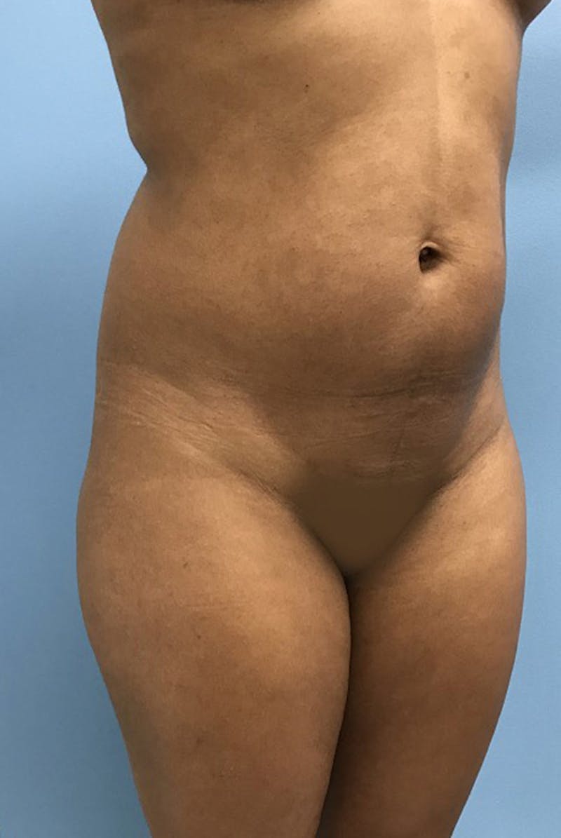 Liposuction Gallery - Patient 120905276 - Image 3