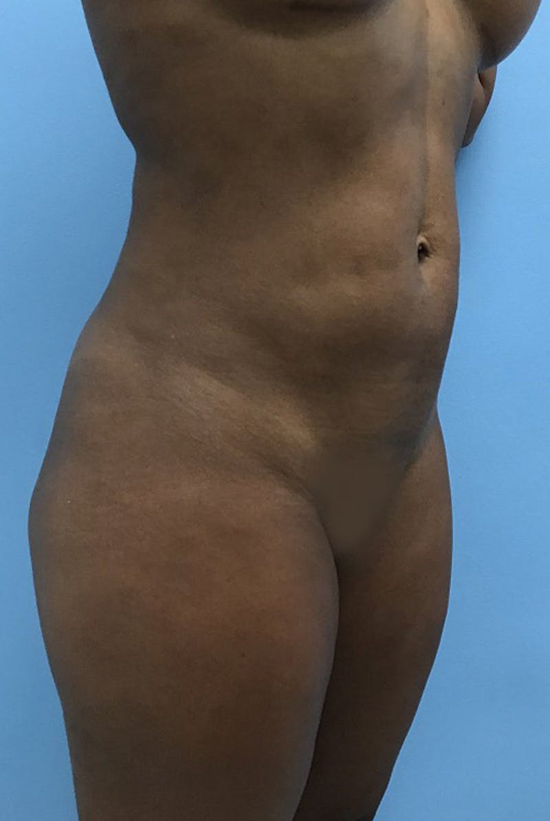 Liposuction Before & After Gallery - Patient 120905276 - Image 4